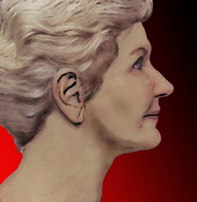 face lift and fat graft of face