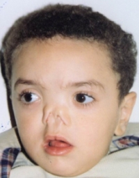 CRANIOFACIL SURGERY