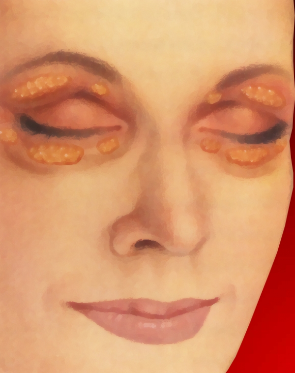 blepharoplasty