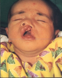 CLEFT LIP AND PALATE