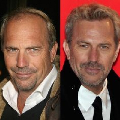 Hair Transplant (Hair Loss Treatment)