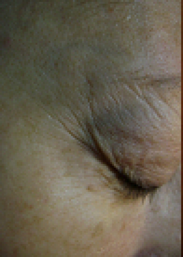 LASER IN PLASTIC SURGERY