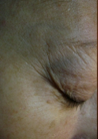 LASER IN PLASTIC SURGERY