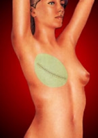 Breast Reconstruction