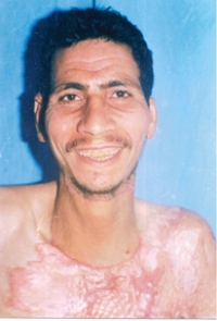 BURN DEFORMITIES CORRECTION