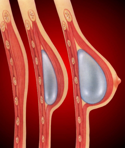Breast cosmetic surgery