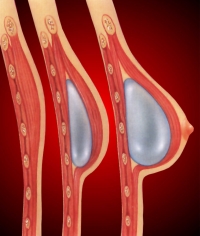 Breast cosmetic surgery